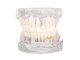Dental Jaw Model with 14 Removable Teeth & Implants