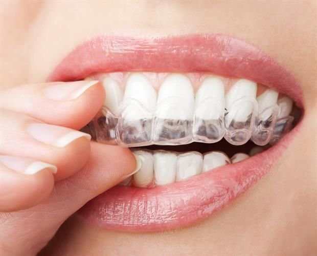 Anti Grinding Night Dental Teeth Mouth Guard Protection (2)