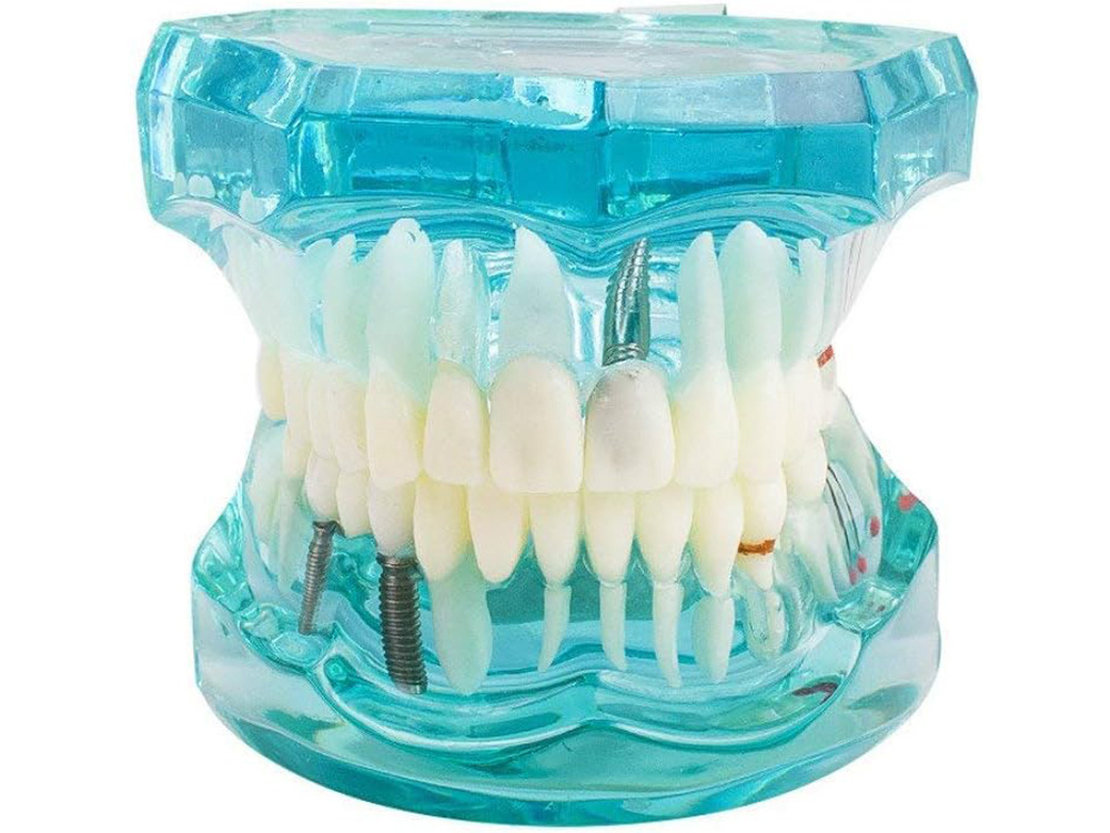Dental Model Jaw Teeth Implants (1)