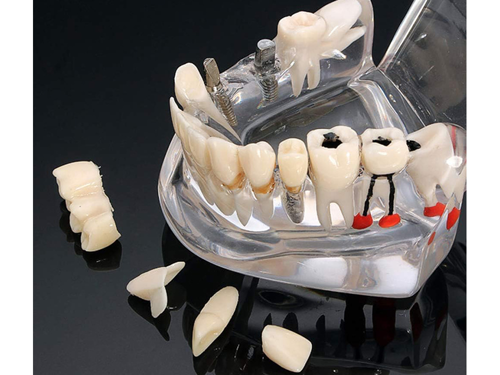 Dental Model Jaw Teeth Implants (2)