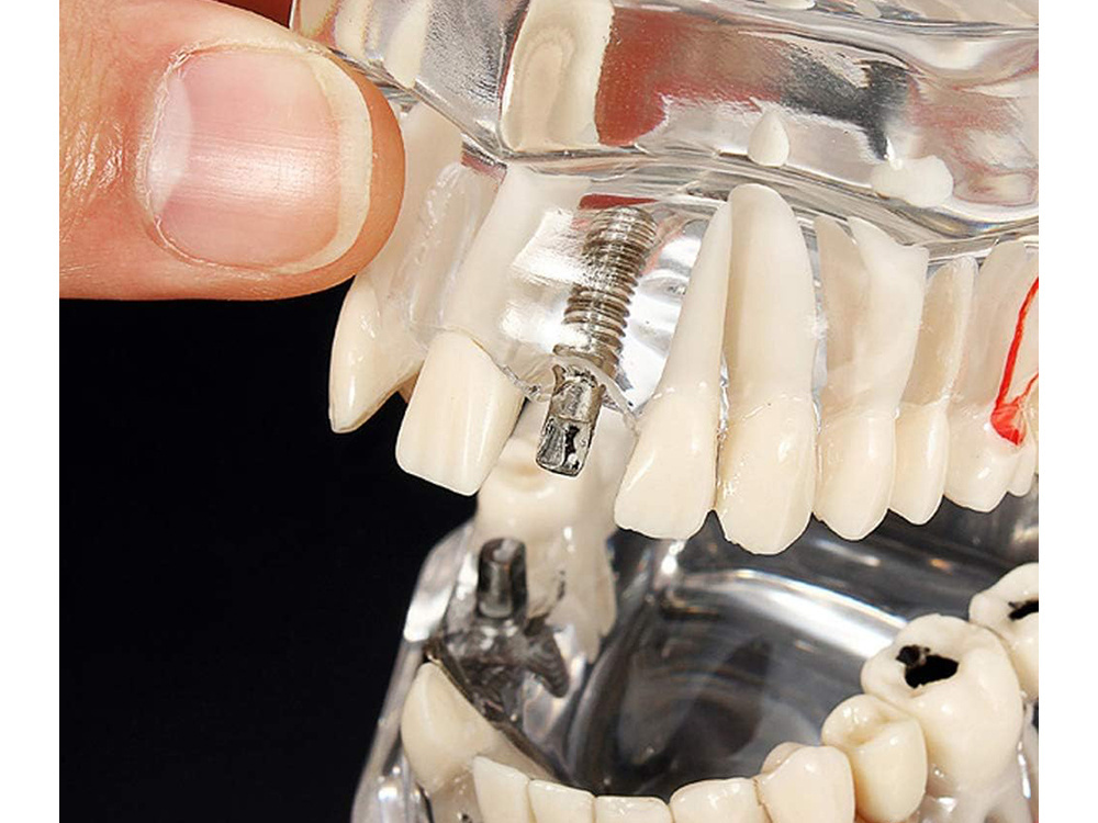 Dental Model Jaw Teeth Implants (3)